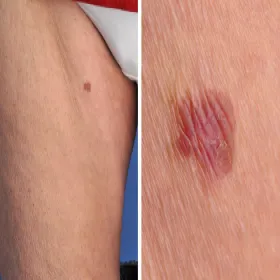 Choroba Bowena na udzie