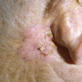 Choroba Bowena narośl za uchem