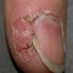 Choroba Bowena palca