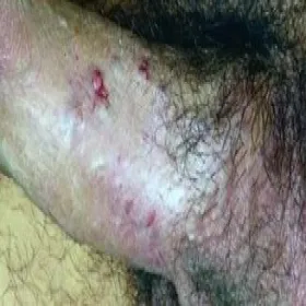 Choroba Bowena prącia