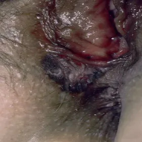 Choroba Bowena rak sromu