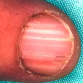 Choroba Dariera na paznokciu