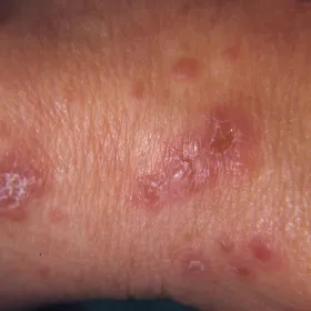 Choroba Duhringa objawy kliniczne rumienie