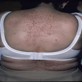 Choroba Grovera u kobiet