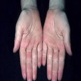 Choroba Kawasaki objawy na dłoniach