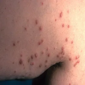 Choroba Kyrle choroba skórna