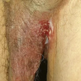 Choroba Pageta u mężczyzn okolic intymnych