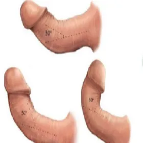 Choroba Peyroniego skrzywienie prącia