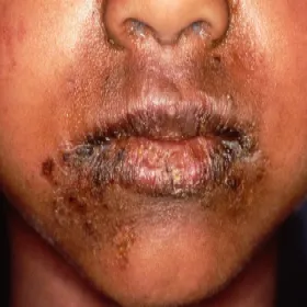 Choroba Rittera u dzieci