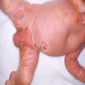 Choroba Rittera u niemowląt objawy