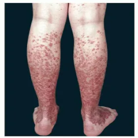 Choroba Schamberga na nogach