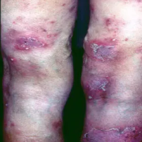 Choroba Sneddona - Wilkinsona zdjęcie