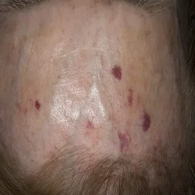 Choroba autoimmunologiczna zespół Thibierge`a-Weissenbacha