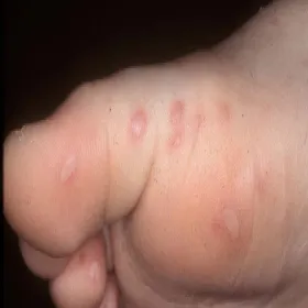 Choroba bostońska u dorosłych