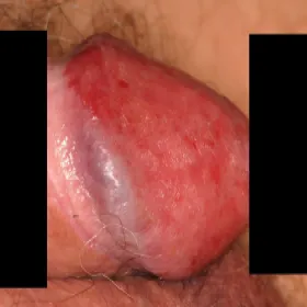 Choroba erytroplazja Queyrata 