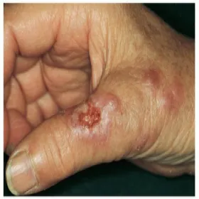 Choroba grzybicza sporotrychoza 