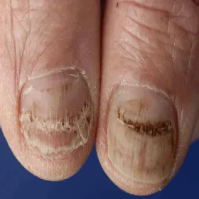 Choroba linie beau na paznokciach