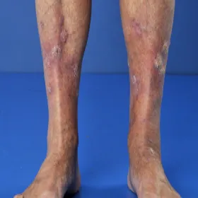 Choroba liszaj płaski na nogach