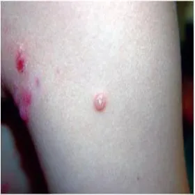 Choroba mięczak zakaźny 