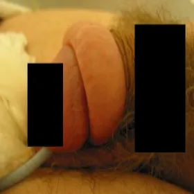 Choroba napletka załupek