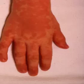 Choroba odra wysypka na rękach dziecka