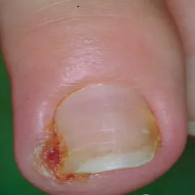 Choroba paznokci onychokryptoza