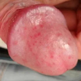 Choroba penisa balanitis  