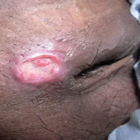 Choroba przenoszona drogą płciową ziarniniak pachwinowy 