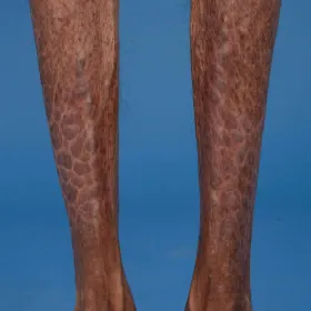 Choroba skórna rybia łuska sprzężona z chromosomem X