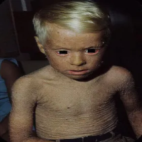 Choroba skórna rybia łuska u dziecka zdjęcie