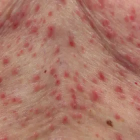 Choroba skóry choroba Grovera