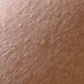 Choroba skóry liszaj lśniący 