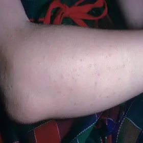 Choroba skóry u dziecka na ręce liszaj lśniący 