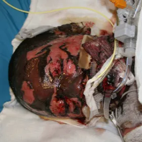 Choroba toksyczna martwica rozpływna naskórka