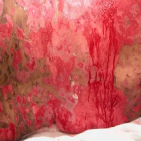 Choroba toksyczne martwicze oddzielanie się naskórka