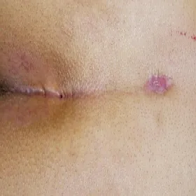 Choroba torbiel włosowa 