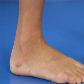 Choroba tropikalna tungoza