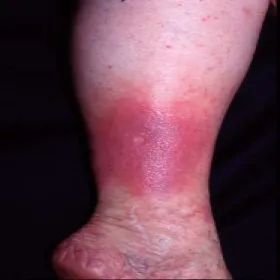 Choroba wyprysk podudzi 