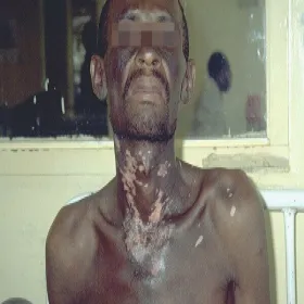 Choroba wywołana niedoborem witaminy PP