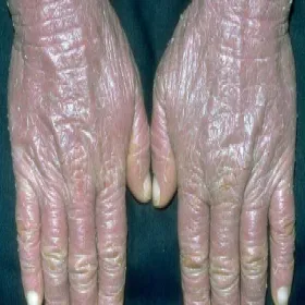 Choroba zespół Sezary’ego na skórze dłoni