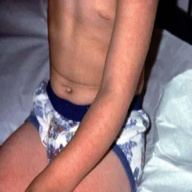 Choroba zakaźna u dzieci 