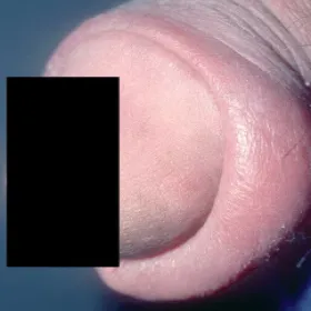 Choroby chłopców załupek