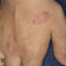 Choroby dłoni wyprysk pieniążkowaty 