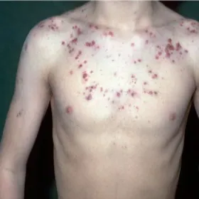 Choroby dermatologiczne trądzik piorunujący