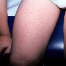 Choroby dziecięce z wysypką zdjęcia 