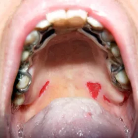 Choroby jamy ustnej pęcherzyca zwykła