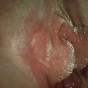 Choroby kobiecych narządów płciowych rogowacenie białe sromu 