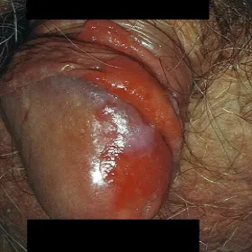 Choroby męskie erytroplazja Queyrata