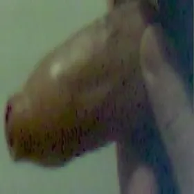 Choroby męskie stulejka