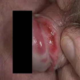 Choroby męskie zapalenie napletka